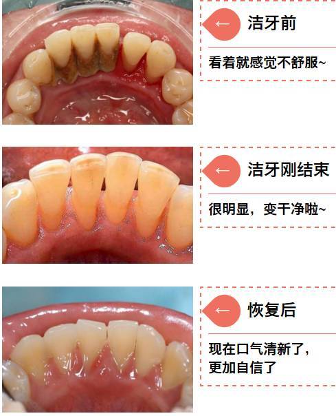 牙菌斑能刷掉吗?深度洗牙收费-图3 牙菌斑能刷掉吗?深度洗牙收费-图3