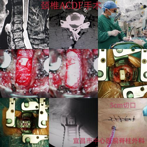颈椎病手术要多少钱？按颈椎收费标准